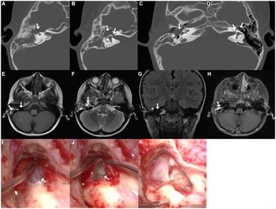 Fallopian canal arachnoid cyst with acute facial nerve paralysis in children: a report of two cases and literature review